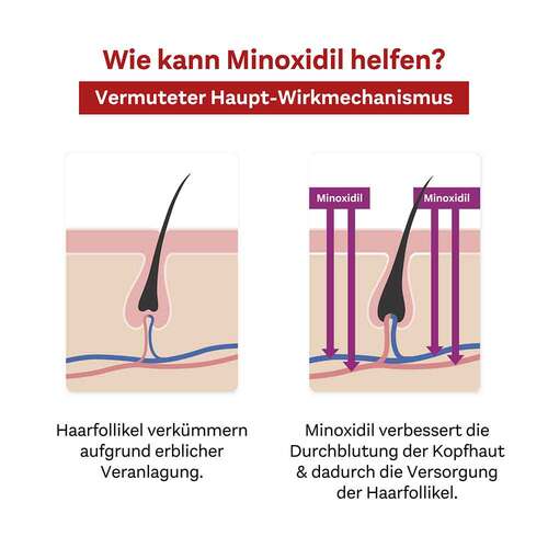 MINOXIDIL DoppelherzPharma 20 mg/ml L&ouml;sung f&uuml;r Frauen - 7